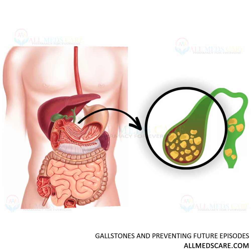 Naturally Cure Gallstones and Prevent Future Episodes - Allmedscare.com
